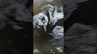 Fetal Hydrocele amp Indirect Inguinal Hernia  Ultrasound [upl. by Stella]