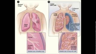 Lymphatic system diseases [upl. by Eenar330]