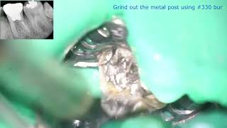 Root Canal Treatment Metal Cast Post Removal of Mandibular Molar [upl. by Egreog]