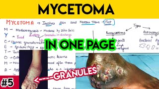 Mycetoma explained in simplified way with mnemonic 🤯  mycology microbiology MCWA [upl. by Sennahoj]