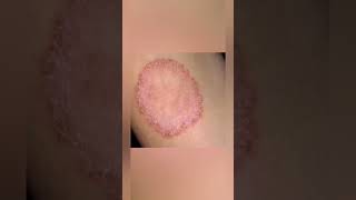 Ring worm infection Cure at Home Padar thamarai in Tamil shorts skincare [upl. by Natlus]