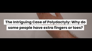 The Intriguing Case of Polydactyly Why do some people have extra fingers or toes [upl. by Telrahc]