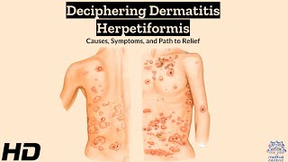 Dermatitis Herpetiformis Explained Symptoms Triggers and Relief [upl. by Diao]