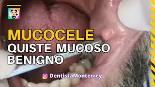 MUCOCELE 👅 QUISTE MUCOSO BENIGNO dental [upl. by Orual]