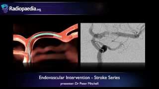 Stroke Endovascular management of ischaemic stroke  radiology video tutorial [upl. by Ttik101]