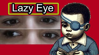 Lazy Eye Amblyopia From Diagnosis to Full Recovery Causes Effects and Treatment Strategies [upl. by Lenneuq167]