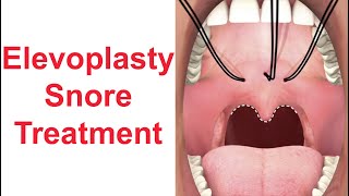 Elevoplasty Snore Treatment [upl. by Brink]