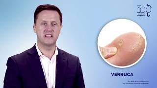 Understand and Manage Wart amp Verruca [upl. by Lizned]