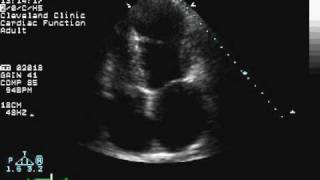 Apical Wall Motion Abnormality [upl. by Sumahs]