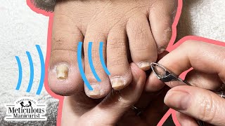 Pedicure Tutorial How to Fix Pincer Toenails [upl. by Nnaear]