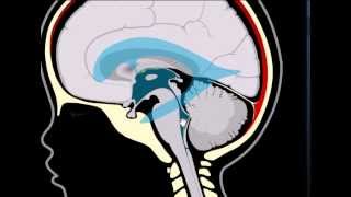 Terceiroventriculostomia ou neurocirurgia endoscópica [upl. by Zsa478]