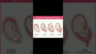 Types of placenta previa implantation  bleeding 🩸knowledge medical shortvideo share [upl. by Lazar189]