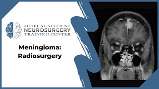 Meningioma Radiosurgery [upl. by Tormoria]