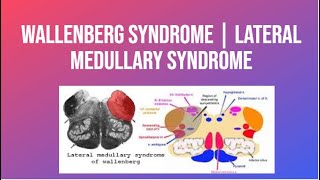 Wallenberg Syndrome  Lateral Medullary Syndrome  PhysiotherapyKnowledge [upl. by Hachman]