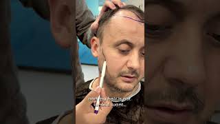 The Philosophy of Hair by Dr Ali Sahan hairtransplant beardtransplantturkey [upl. by Leidgam688]