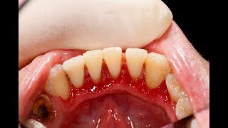 Periodontal Disease Treatment Options with Dr Joe Nemeth amp Dr Tom McCawley [upl. by Collum]