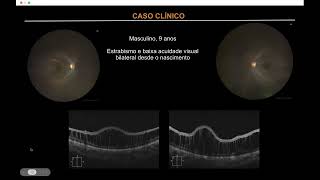 Reuniao Retina 12092024 [upl. by Tabbatha]