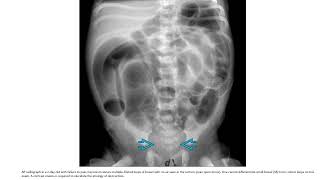 Hirschsprung Disease Imaging [upl. by Martz]