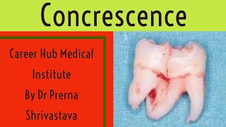 concrescence Developmental tooth anomaly By Dr Prerna Shrivastava career Hub medical institute [upl. by Araht]