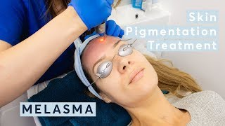 Melasma Skin Pigmentation Treatment using PicoSure Laser [upl. by Kunz]