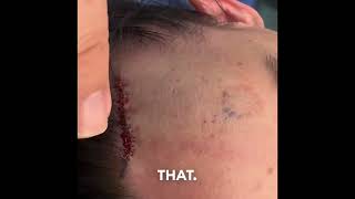 Osteoma or Lipoma Forehead Removal [upl. by Mendez]