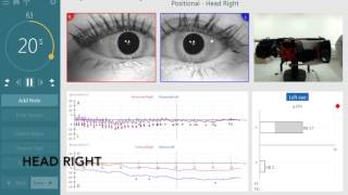 BPPV Assesment with the new TRV Chair by Interacoustics [upl. by Anawaj]