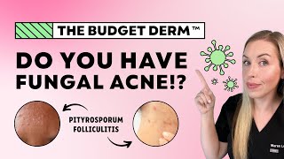 5 Signs You Have Fungal Acne…NOT Regular Acne  The Budget Derm Explains [upl. by Wilkison]