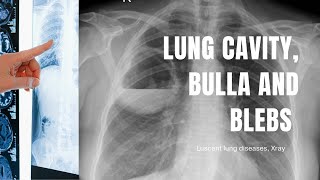 Cavity bulla blebs abscess in a Chest Xray How to differentiate [upl. by Nwaf]