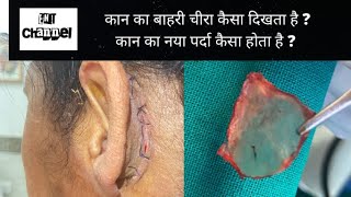 Outer incision for ear operation  How does new eardrum membrane looks like [upl. by Irehc41]