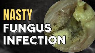 NASTY Fungus Infection Thoroughly Cleaned [upl. by Ravi204]