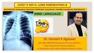 Radiology Chest X Ray5 HINDI Bronchiectasis Emphysema ILD Pulmonary Edema NoduleDr Hemant [upl. by Pax]