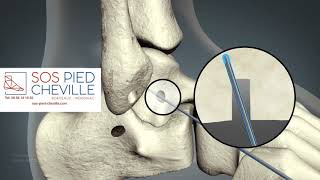 Ligamentoplastie de reconstruction [upl. by Daj]