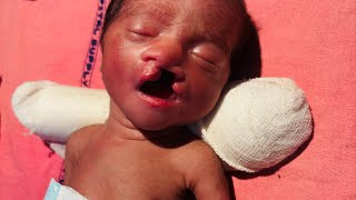 Showing Cleft Lip Cleft Palate on Livecreativityislife [upl. by Jacquelyn395]