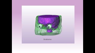 3D Presentation of types of Strabismus [upl. by Marx551]