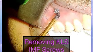 Long Version IMF Screw Removal for Closed Reduction of Mandible Fracture [upl. by Eesak]