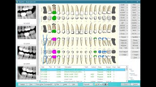 Eaglesoft  Patient Chart [upl. by Cirre158]