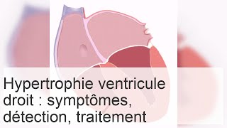 Causes et diagnostic de lhypertrophie du ventricule droit [upl. by Nodnek]