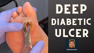 DEEP Diabetic Foot Ulcer podiatristfoot and ankle specialist treats a foot ulcer [upl. by Krista]