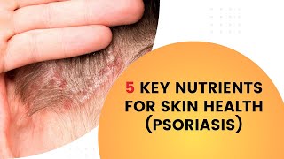 5 Key Nutrients for Skin Health Psoriasis [upl. by Neetsirhc957]