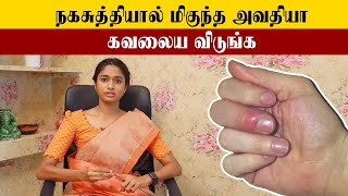 How to Cure Paronychia  நகசுத்தி குணப்படுத்துவது எப்படி  Samayam Tamil [upl. by Sandor]