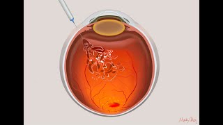 AntiVEGF intravitreal injection [upl. by Calmas]