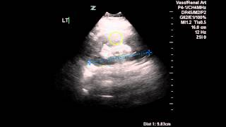 Normal Renal Arterial Doppler  Case Study [upl. by Apeed345]