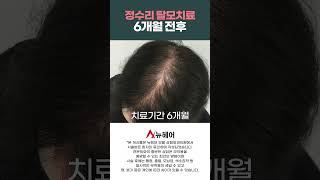 탈모약 안 먹고 머리숱 많아지는 법ㅣ모낭주사 탈모주사치료 6개월 전후 [upl. by Nodab]