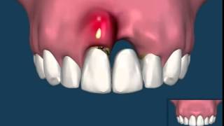 The Difference Between A Dental Bridge and Dental Implants [upl. by Patterson]