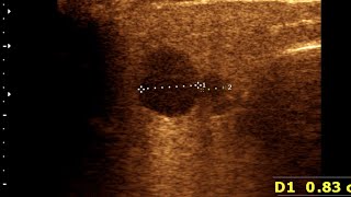 Parotitis  Lymphadenitis  Normal Thyroid Gland [upl. by Eicnarf]