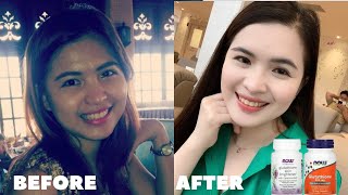 GLUTATHIONE BEFORE AND AFTER How to whiten skin [upl. by Ellesij]