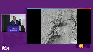 Advancing percutaneous treatment of pulmonary embolism with computerassisted vacuum thrombectomy [upl. by Magen]