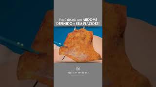 Lipo ou Abdominoplastia Que tal as duas juntas [upl. by Schnabel175]