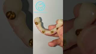 fixed amp removable implant denture dentist dentistry implants [upl. by Hairabez502]