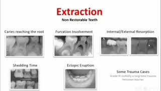 when to extract the deciduous teeth 💯 [upl. by Eilzel]